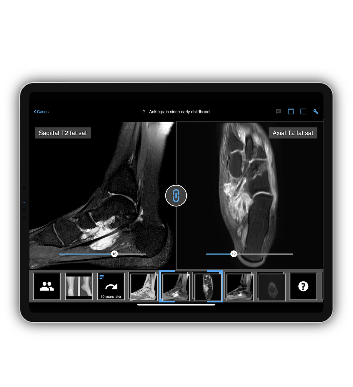 Radiology of foot and ankle: New BerlinCaseViewer module | BerlinCaseViewer