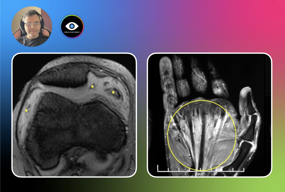 Imaging of Juvenile Idiopathic Arthritis