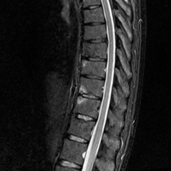 axspa-spine-01