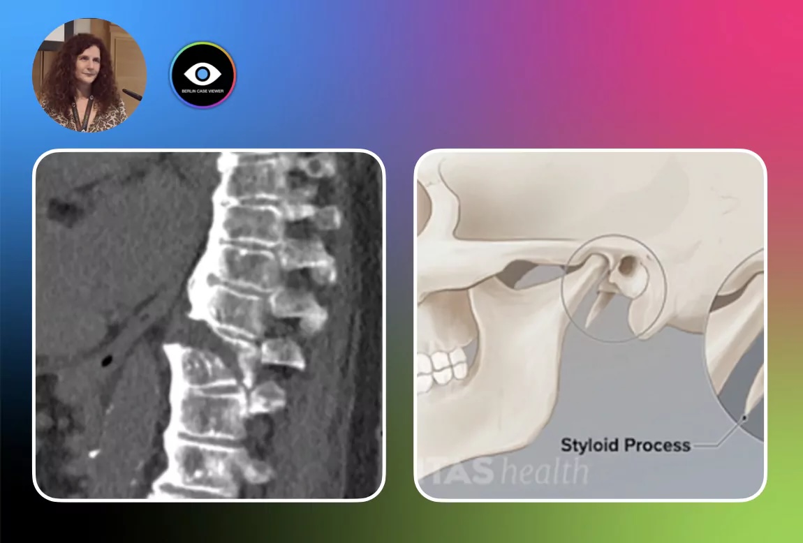Imaging of DISH – More than just Spinal Bony Bridges