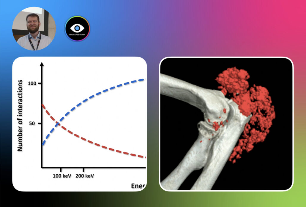 Crystal-Induced Diseases: Role of CT and MRI