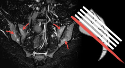 Osteitis condensans ilii as a differential diagnosis for axial spondyloarthritis