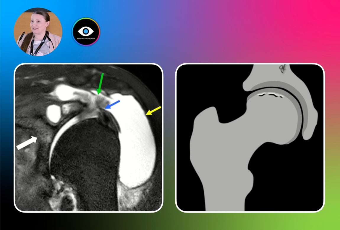 Patterns of Bone Marrow Edema in Large Joints – Mechanical, Inflammatory, or Transient? (Anna Falkowski)