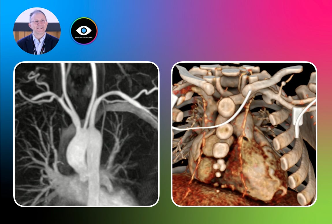Multimodality Imaging in Vasculitis