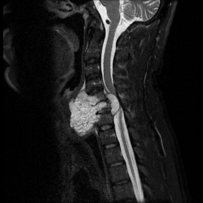 Chordoma cervical spine