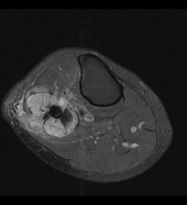 Osteosarcoma Fibula