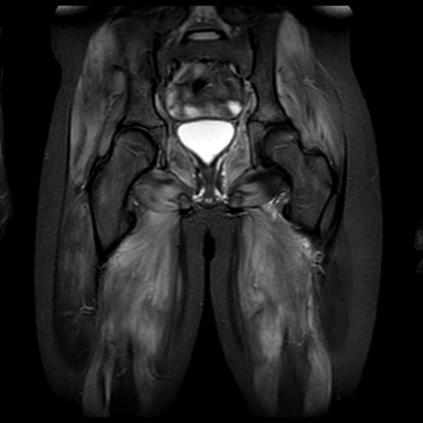 03-Myositis-5.jpg